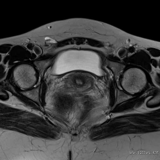 File:Broad ligament fibroid (Radiopaedia 49135-54241 Axial T2 22).jpg