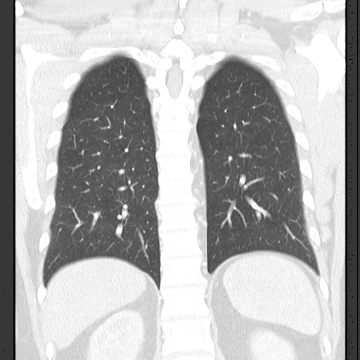 Bronchial carcinoid tumor (Radiopaedia 67377-76764 Coronal lung window 48).jpg