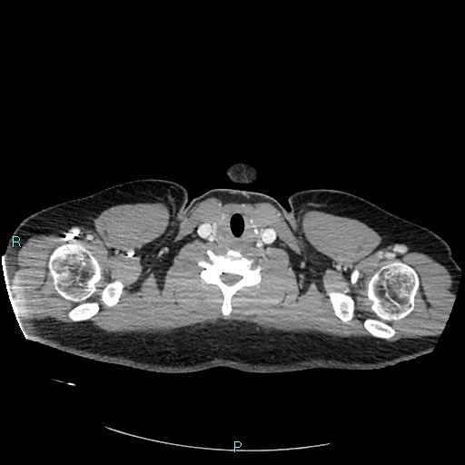 Bronchial carcinoid tumor (Radiopaedia 78272-90875 A 3).jpg