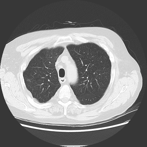 Bronchial stenosis - lung transplant (Radiopaedia 73133-83848 Axial lung window 18).jpg