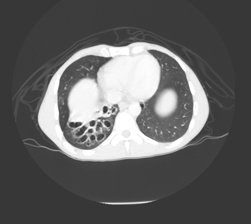File:Bronchiectasis in Crohn disease (Radiopaedia 60311-67977 Axial lung window 14).jpg