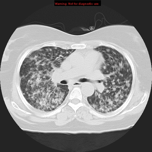 Bronchoalveolar carcinoma (Radiopaedia 13224-13233 Axial lung window 21).jpg