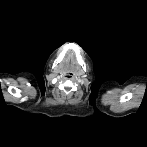 Bronchogenic carcinoma (Radiopaedia 73497-84262 A 4).jpg