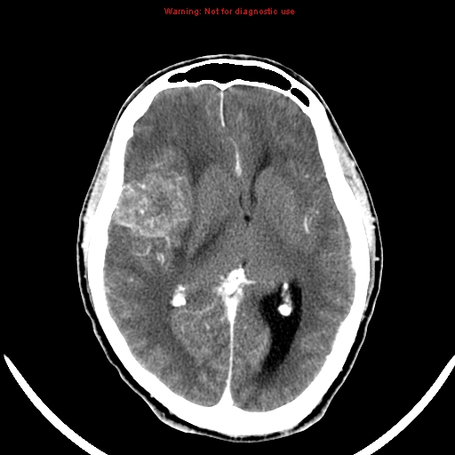 File:Bronchogenic carcinoma brain metastasis (Radiopaedia 9286-9970 B 14).jpg