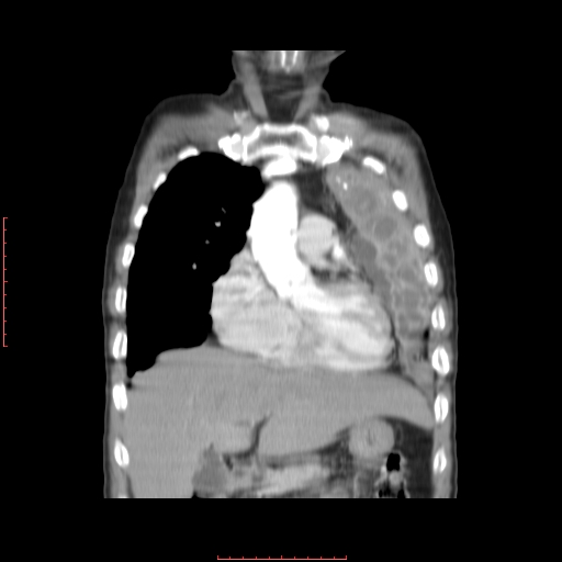 File:Bronchogenic carcinoma with left atrial large deposit - T4N3M1a (Radiopaedia 42316-45428 B 5).jpg