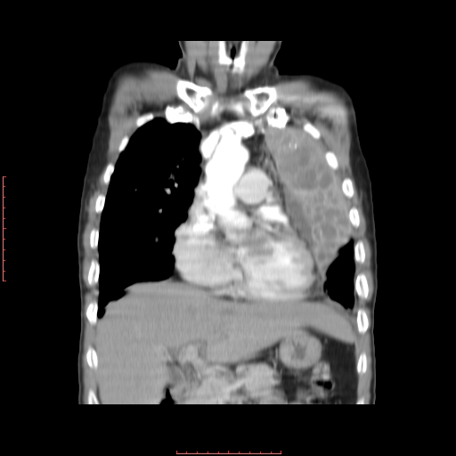 File:Bronchogenic carcinoma with left atrial large deposit - T4N3M1a (Radiopaedia 42316-45428 B 6).jpg