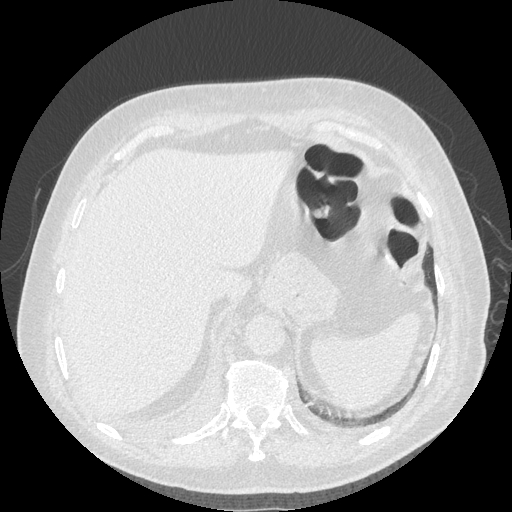 Bronchogenic carcinoma with metastatic lymphadenopathy (Radiopaedia 37671-39569 Axial lung window 49).jpg
