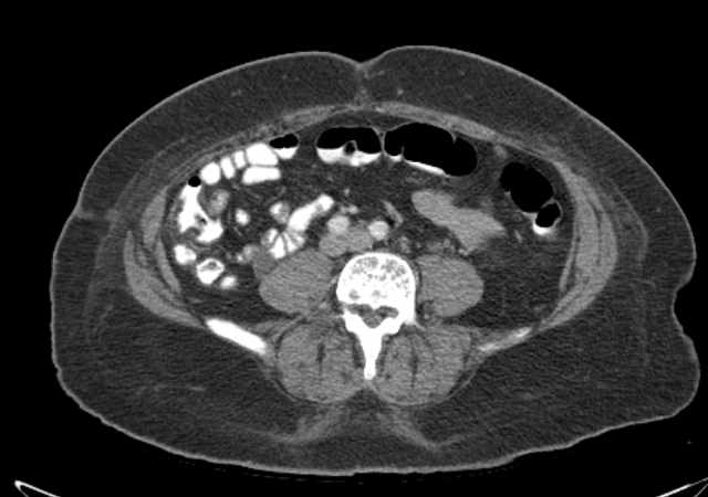 Brown tumors compressing the spinal cord (Radiopaedia 68442-77988 E 77).jpg