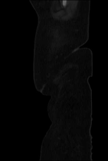 Brown tumors compressing the spinal cord (Radiopaedia 68442-77988 H 2).jpg