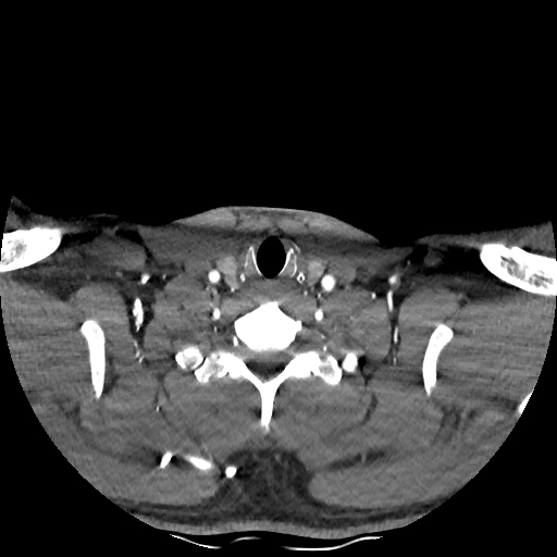 Buccal fat pad arteriovenous malformation (Radiopaedia 70936-81144 D 71).jpg