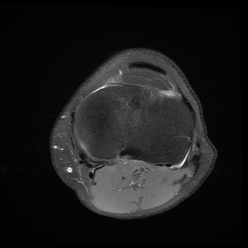 File:Bucket-handle meniscus tear (Radiopaedia 65700-74809 Axial PD fat sat 20).jpg