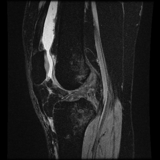 File:Bucket handle meniscus tear (Radiopaedia 56916-63751 H 38).jpg