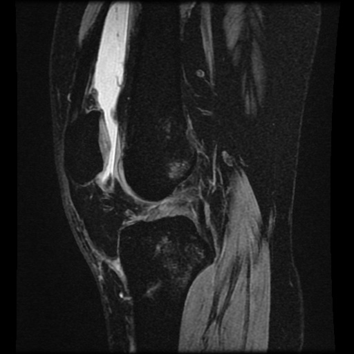 Bucket handle meniscus tear (Radiopaedia 56916-63751 H 43).jpg