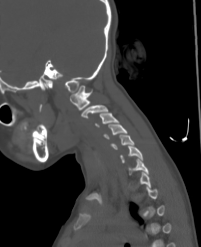 File:Butterfly vertebra (Radiopaedia 77903-90209 Sagittal bone window 87).jpg