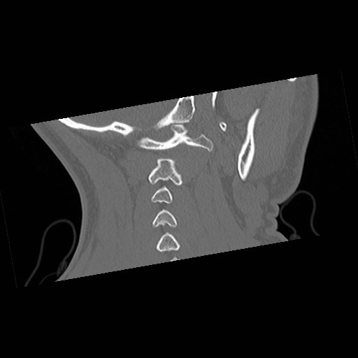 C1-C2 "subluxation" - normal cervical anatomy at maximum head rotation (Radiopaedia 42483-45607 Coronal non-contrast 47).jpg