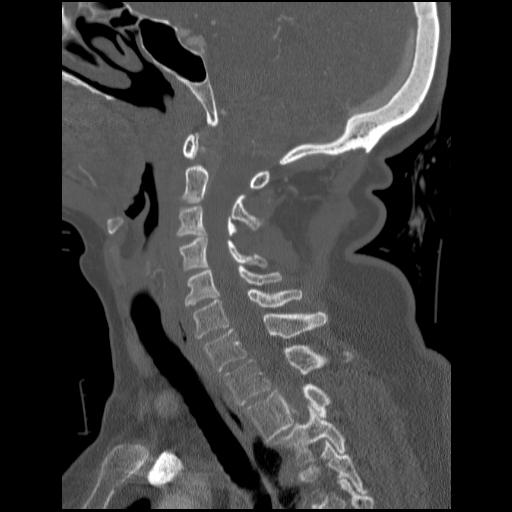 File:C1 anterior arch (plough) fracture - type 1 (Radiopaedia 76181-87720 Sagittal bone window 55).jpg