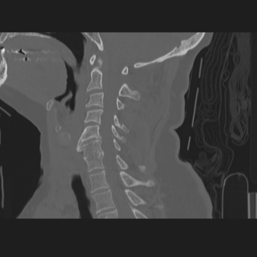 File:C2 fracture (Radiopaedia 34091-35341 Sagittal bone window 41).png