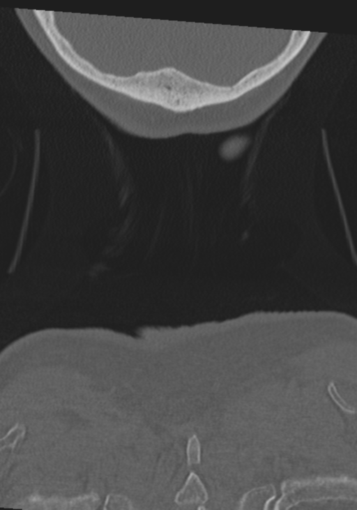 C2 fracture with vertebral artery dissection (Radiopaedia 37378-39199 Coronal bone window 68).png