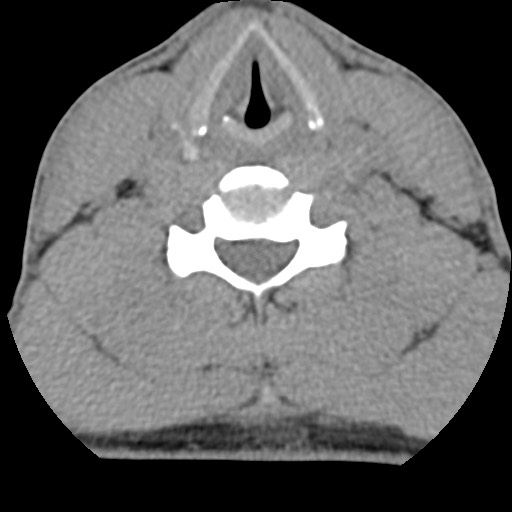 C5 facet fracture (Radiopaedia 58374-65499 Axial non-contrast 59).jpg