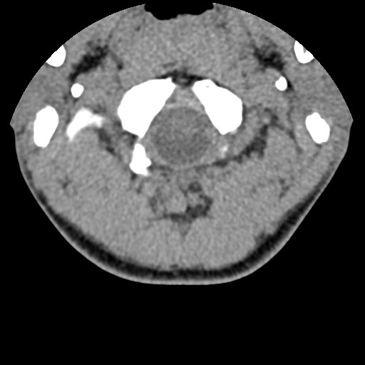 File:C5 facet fracture (Radiopaedia 58374-65499 Axial non-contrast 9).jpg