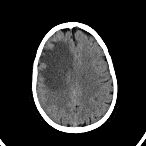 File:CNS Lymphoma (Radiopaedia 44198-47794 Axial non-contrast 25).png