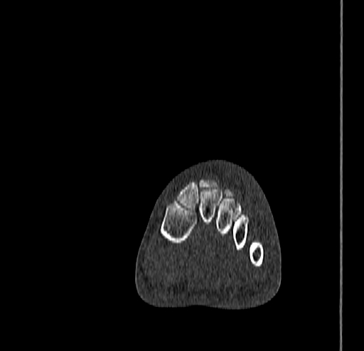 Calcaneal fracture - Sanders type 4 (Radiopaedia 90179-107370 Coronal bone window 38).jpg