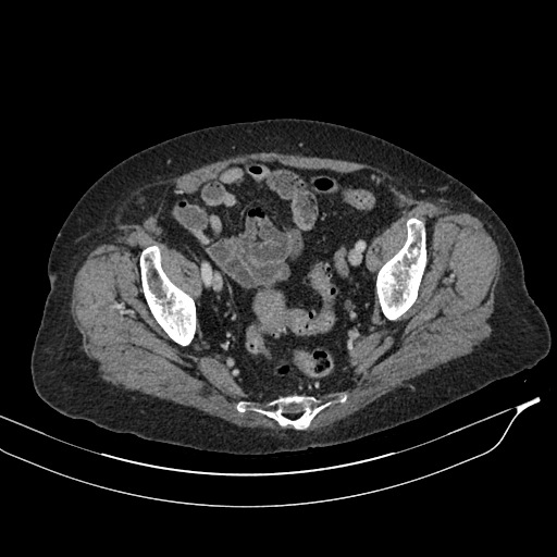 Calcified adrenal glands and Spigelian hernia (Radiopaedia 49741-54988 A 203).jpg