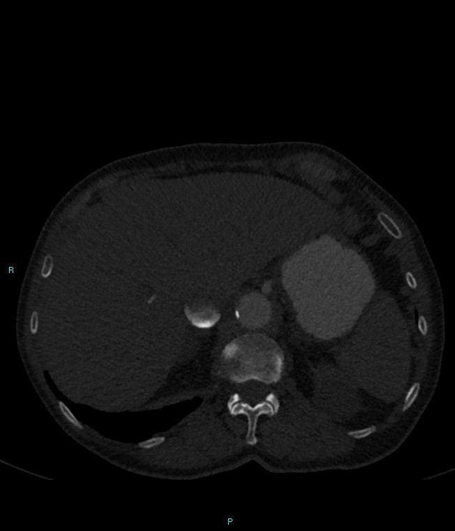 Calcified cerebral emboli from left ventricular thrombus (Radiopaedia 84420-99760 Axial bone window 80).jpg