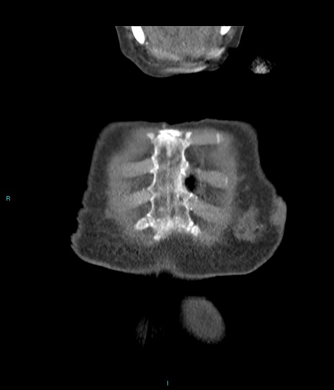 Calcified cerebral emboli from left ventricular thrombus (Radiopaedia 84420-99760 Coronal C+ CTPA 69).jpg