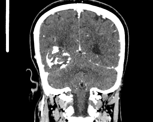 Calcified cerebral hydatid cyst (Radiopaedia 65603-74717 C 53).jpg