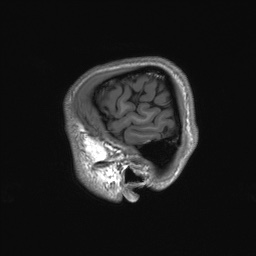 Callosal dysgenesis with interhemispheric cyst (Radiopaedia 53355-59335 Sagittal T1 160).jpg