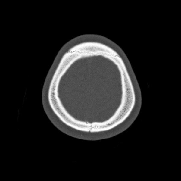 Calvarial osteoma (Radiopaedia 36520-38079 Axial bone window 97).jpg