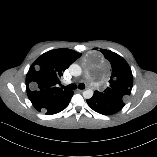 Cannonball metastases - testicular choriocarcinoma (Radiopaedia 84510-99891 B 50).jpg