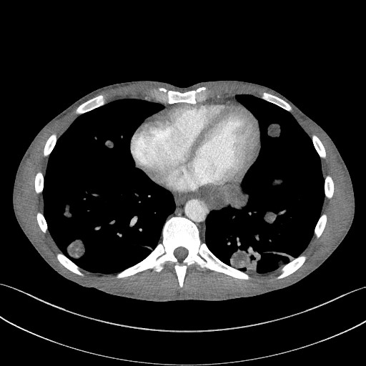 Cannonball metastases - testicular choriocarcinoma (Radiopaedia 84510-99891 B 77).jpg
