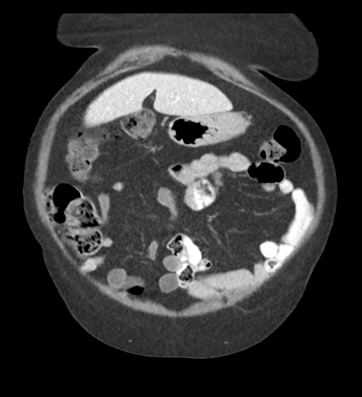 Cannonball metastases from endometrial cancer (Radiopaedia 42003-45031 F 17).png