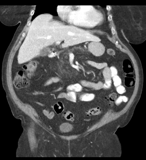 File:Cannonball metastases from endometrial cancer (Radiopaedia 42003-45031 F 28).png
