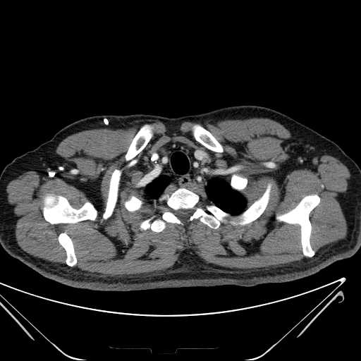 File:Cannonball pulmonary metastases (Radiopaedia 67684-77101 D 23).jpg