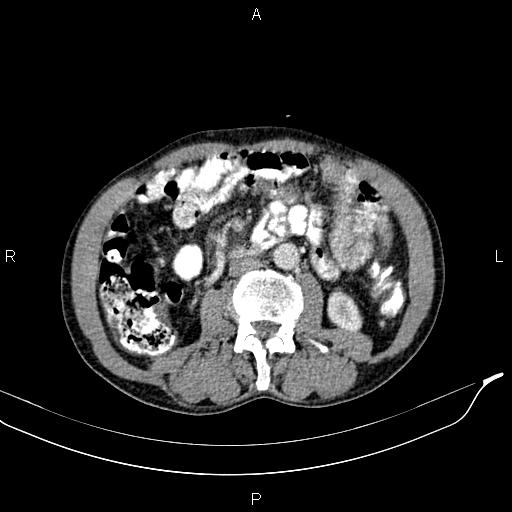 File:Caput medusae sign - portal hypertension (Radiopaedia 64007-72759 A 49).jpg