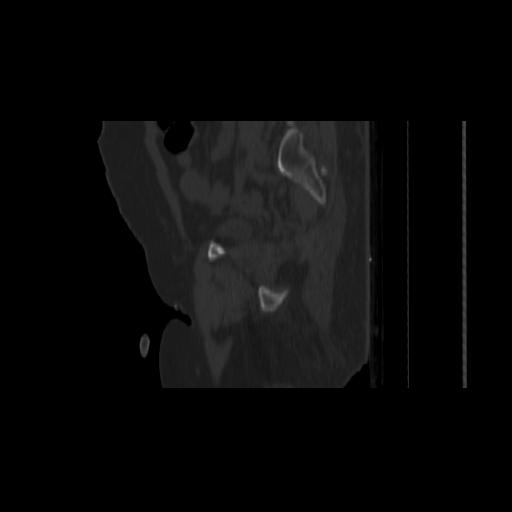 Carcinoma cervix- brachytherapy applicator (Radiopaedia 33135-34173 Sagittal bone window 137).jpg