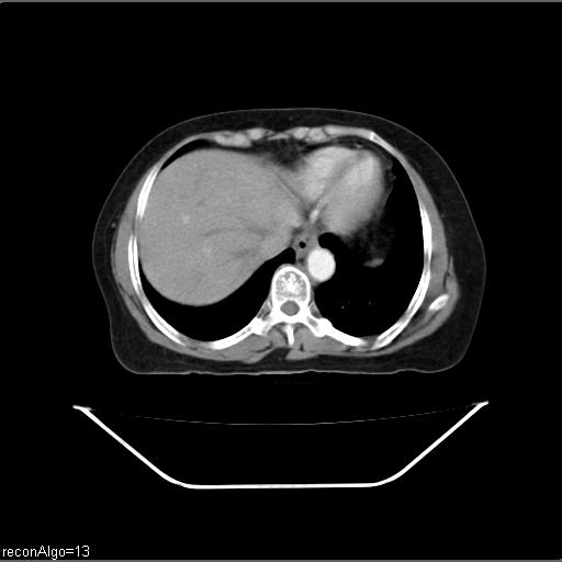 Carcinoma cervix- recurrence (Radiopaedia 34702-36137 B 7).jpg