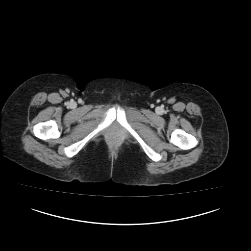 Carcinoma colon - hepatic flexure (Radiopaedia 19461-19493 A 136).jpg