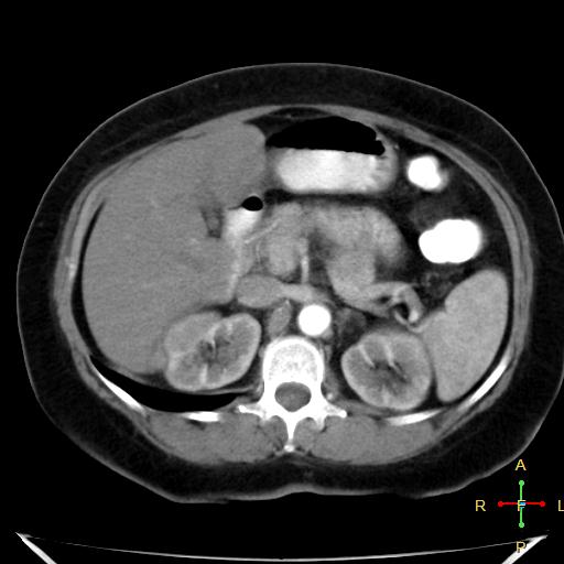 File:Carcinoma of sigmoid colon (Radiopaedia 23071-23100 C+ arterial phase 8).jpg