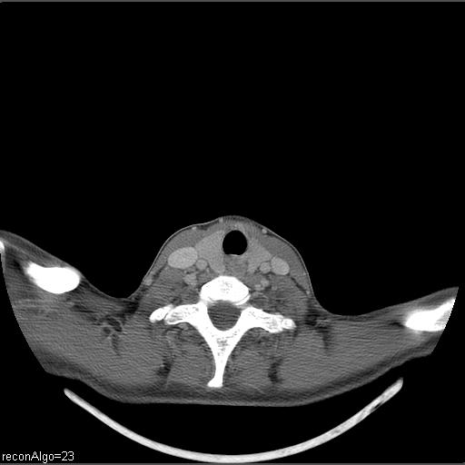 Carcinoma of the maxillary antrum (Radiopaedia 53805-59888 Axial C+ delayed 8).jpg