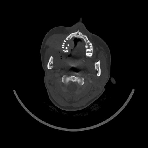 Carcinoma of the maxillary antrum (Radiopaedia 53805-59888 Axial bone window 74).jpg