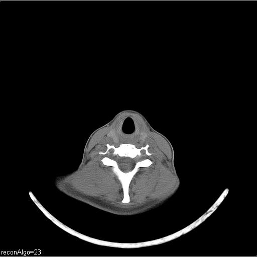 Carcinoma of the maxillary antrum (Radiopaedia 53805-59888 Axial non-contrast 21).jpg