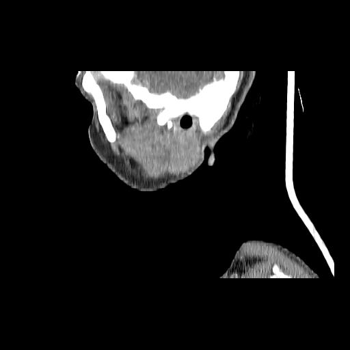 Carcinoma of the maxillary antrum (Radiopaedia 53805-59888 Sagittal C+ delayed 160).jpg