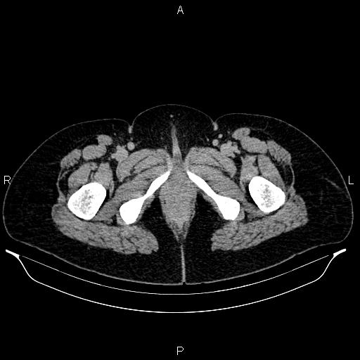 File:Carcinoma of uterine cervix (Radiopaedia 85861-101700 Axial C+ delayed 97).jpg