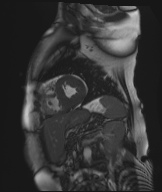 Cardiac amyloidosis (Radiopaedia 51404-57150 Sagittal CINE SSFP 137).jpg
