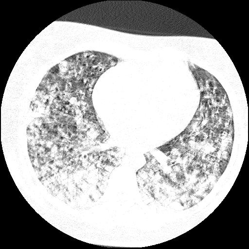 File:Cardiac angiosarcoma (Radiopaedia 66010-75181 Axial lung window 37).jpg