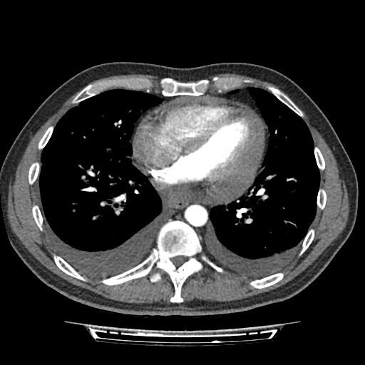 Cardiac tamponade (Radiopaedia 78607-91368 Axial C+ CTPA 58).jpg